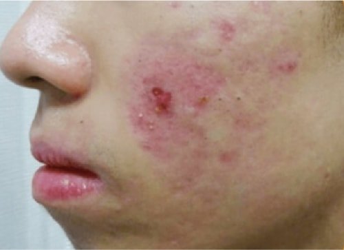 Лечение акне перед
