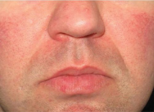 Сосудистое лечение 2 Перед