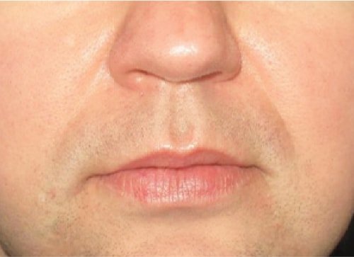 Сосудистое лечение 2 после