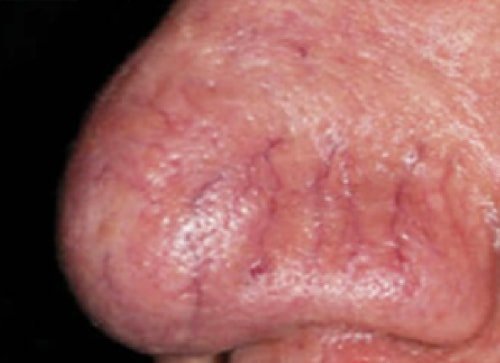 Сосудистое лечение 2 Перед