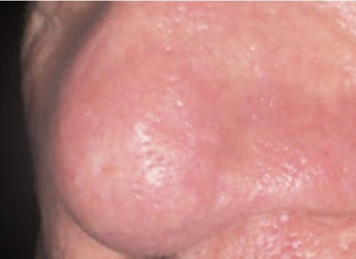 Сосудистое лечение после