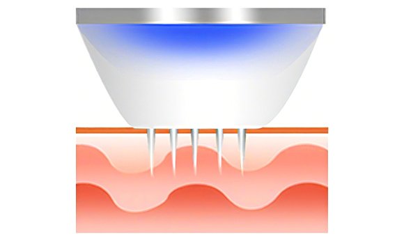 Микроиглы мягко проникают в кожу, причиняя при этом минимальную боль.