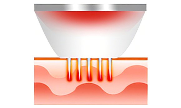 Биполярная радиочастотная энергия денатурирует ткани, окружающие микроиглы.