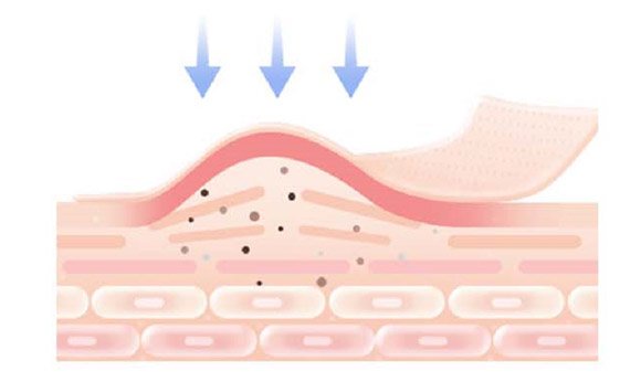 Узкополосная терапия для лечения Lummeca
