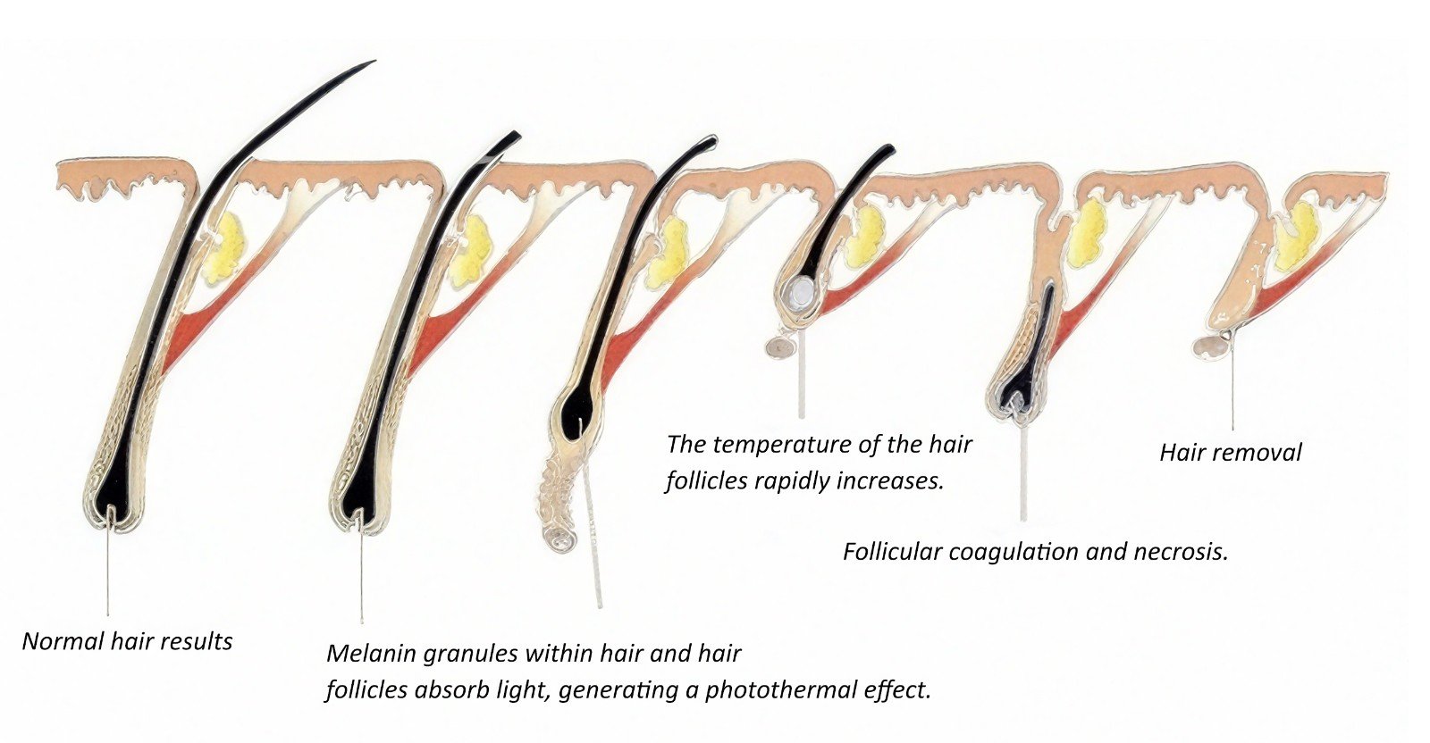 Hair removal ,skin whitening