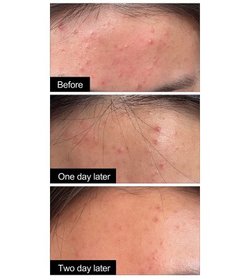 未标题-2_0001_对比图痘痘2天