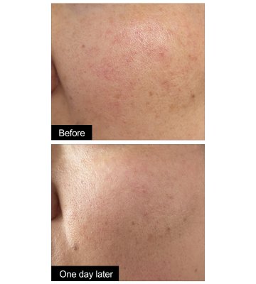 未标题-2_0000_红血丝对比图