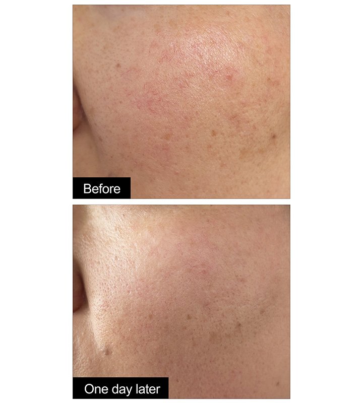 未标题-2_0000_红血丝对比图