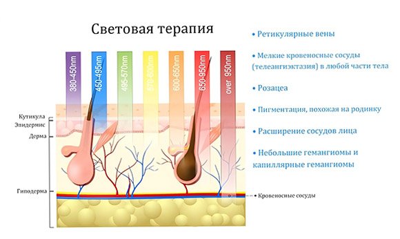 Сосудистые лазеры предназначены для удаления подобных сосудистых поражений.