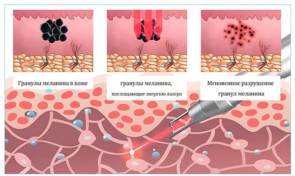 Как работают пикосекундные лазеры?